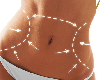 Liposuction Treatment In Delhi By Dr. Monisha Kapoor 