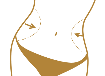 Liposcution Treatment In Delhi By Dr. Monisha Kapoor 