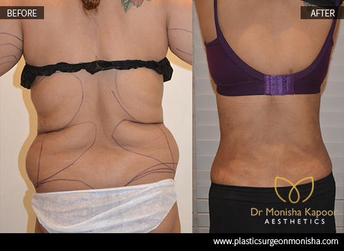 Liposcution Treatment In Delhi By Dr. Monisha Kapoor 