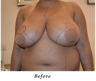 best Breast surgery in India