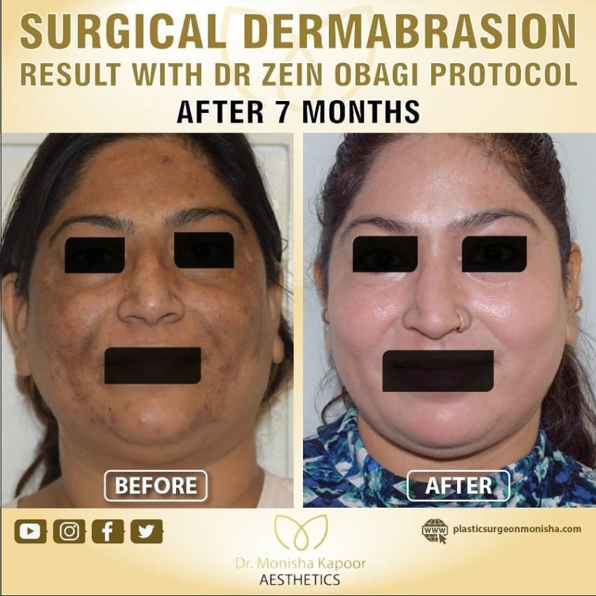 dermabrasion result 