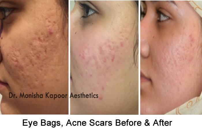 Eye Bags, Acne Scars Removal in Delhi, Indiaby Dr. Monisha Kapooor 