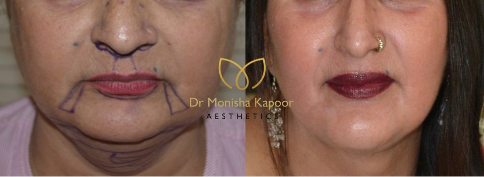 Best way to reduce buccal fat