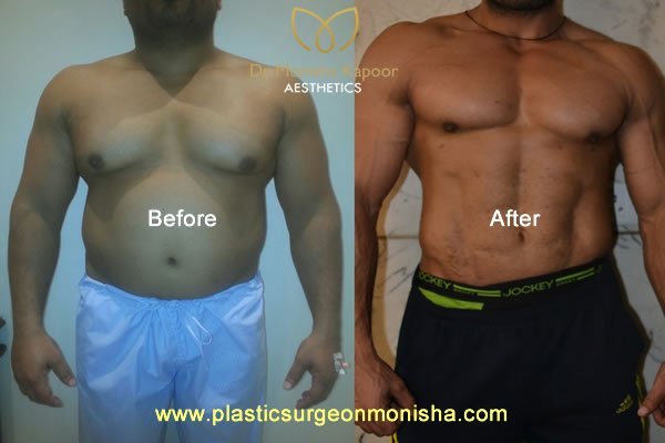 6pack abs and liposuction surgery by plastic surgeon monisha kapoor