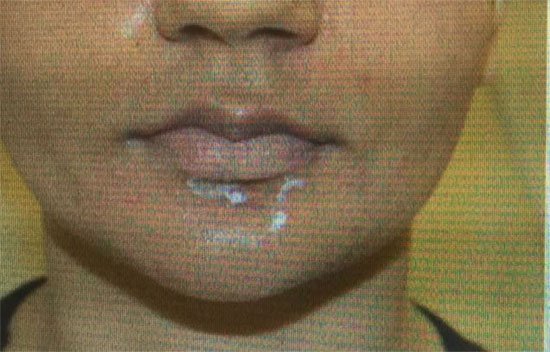 About Permanent Lip Treatment