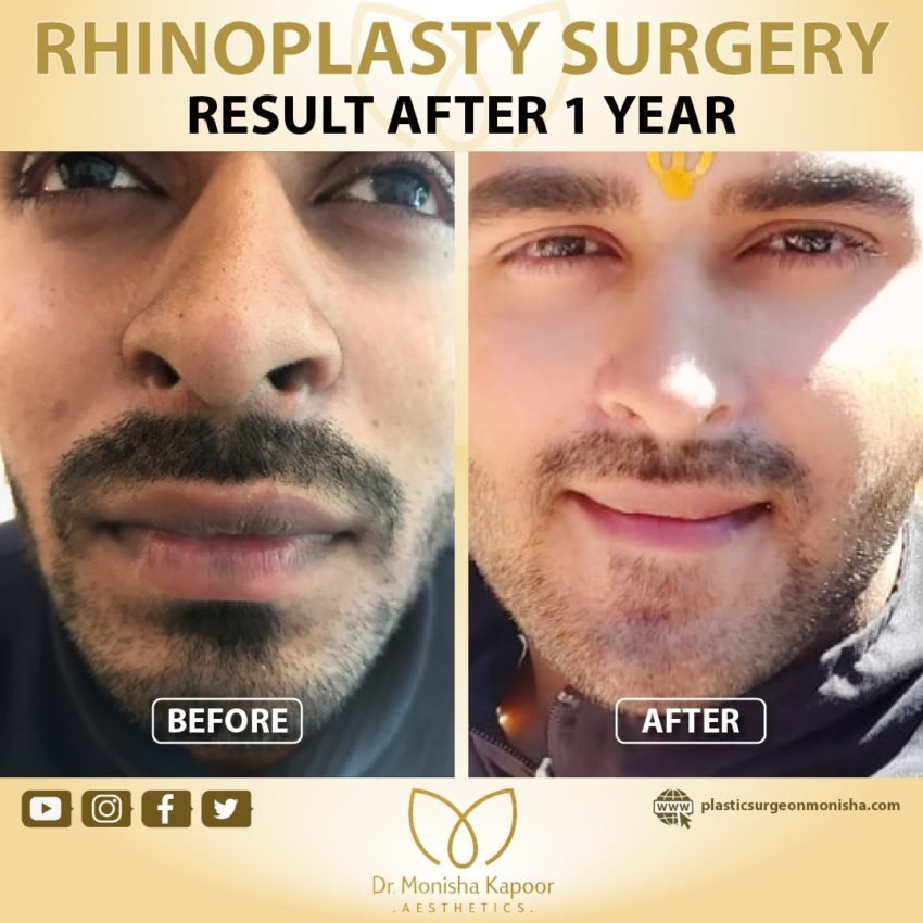 nosejob recovery process and healing guide