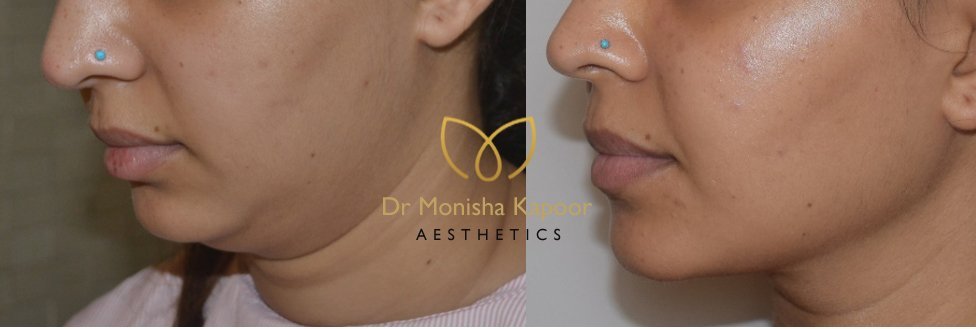 home remedies to reduce cheek fat