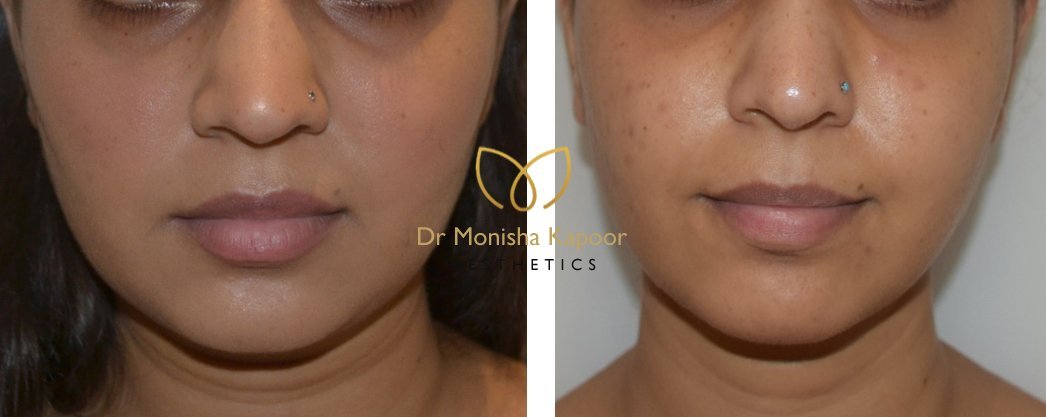 how to reduce face fat | best surgeon Dr. Monisha Kapoor