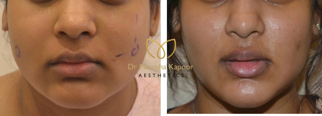 Buccal fat pad removal | tips reduce  face fat