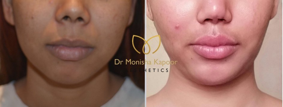 buccal fat pad removal delhi | best surgeon Dr. Monisha Kapoor