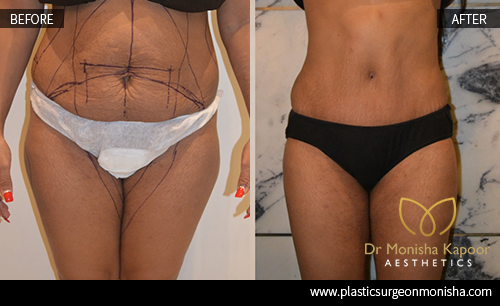 Liposcution Treatment In Delhi By Dr. Monisha Kapoor 
