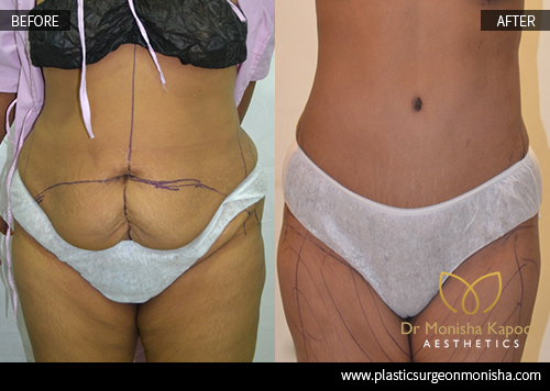Liposcution Treatment In Delhi By Dr. Monisha Kapoor 